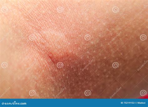 Mosquito Bites On Arm Stock Image Image Of Lonesome 75219153