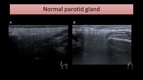 Parotid Gland Ultrasound Measurement