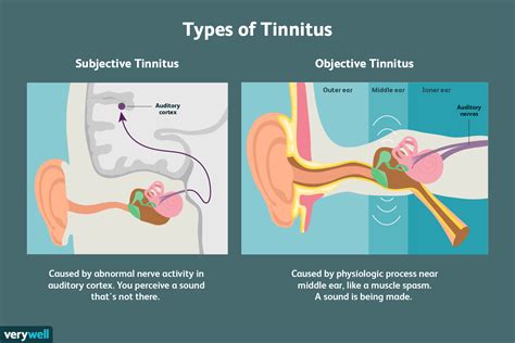 Tinnitus Ringing In The Ears Causes Treatment And More