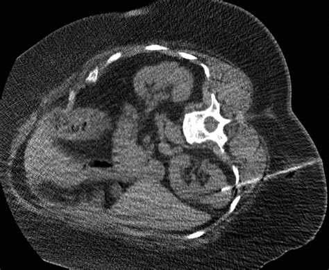 Imaging Guided Percutaneous Renal Biopsy Rationale And Approach Ajr
