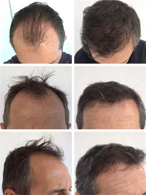 I'd been really ill for two weeks with i found that about 6 months after i was hospitalised whilst travelling in africa, and after the 2015 earthquake in nepal (i was a volunteer there at the time). Before and after hair transplant images - High quality ...
