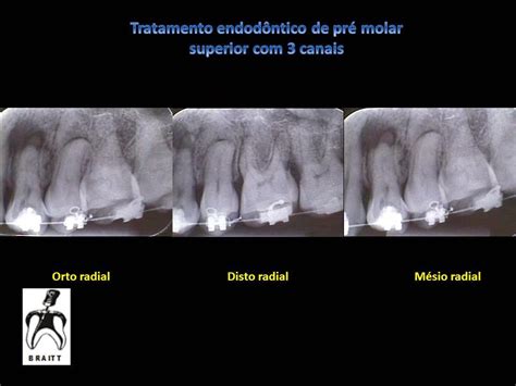 Endodontia Dr Henrique Braitt tratamento endodôntico de pré molar superior com canais