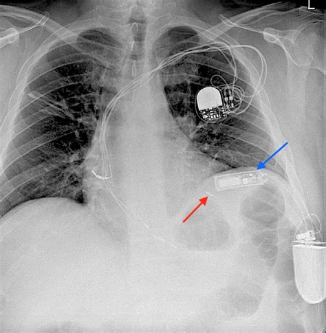 Pacemaker Terminology Questions And Answers In Mri