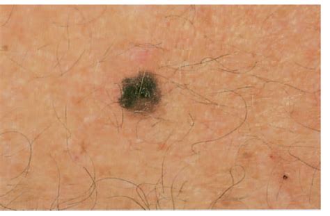 Melanoma Warning Signs And Images The Skin Cancer Foundation