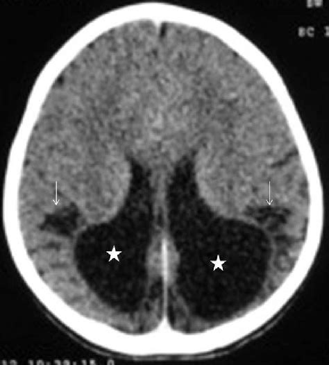Noncontrast Computed Tomography Head Axial In 6‑month Old Term Infant