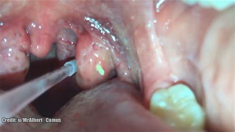 Tonsil Stones Removal Best Tonsillolith Treatment Discussion Youtube