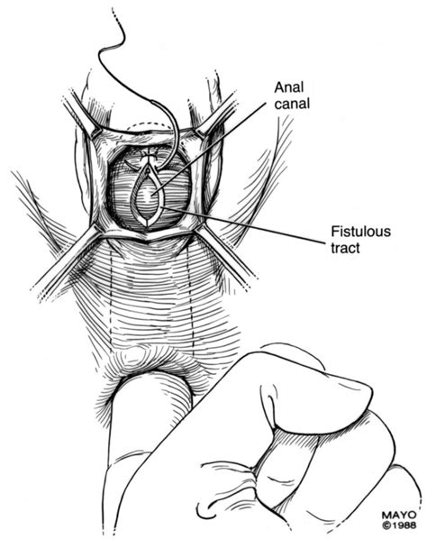 jcm free full text colorectal vaginal fistulas imaging and novel interventional treatment