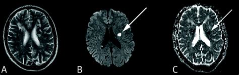 Imaging Transient Ischaemic Attack With Diffusion Weighted Magnetic