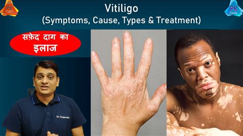 Vitiligo सफ़ेद दाग Leukoderma क्या ठीक हो सकता है Vitiligo
