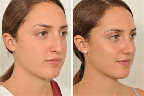Jan 29, 2021 · after one week or so, you'll have another appointment with your doctor to remove your cast! Top Celebrity Rhinoplasty Surgeon, Natural Looking Nose ...