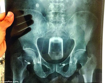 Man Inserts Beer Glass Into His Rear To Ease Constipation Daily Mail Online