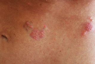 Herpes is an infection caused by hsv (herpes simplex virus). Shingles Rash | Rash associated with the shingles (herpes ...