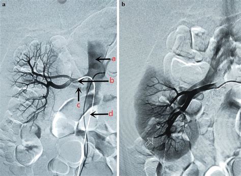 Image Of Right Kidney By Dsa A Angiography From Main Renal Artery A
