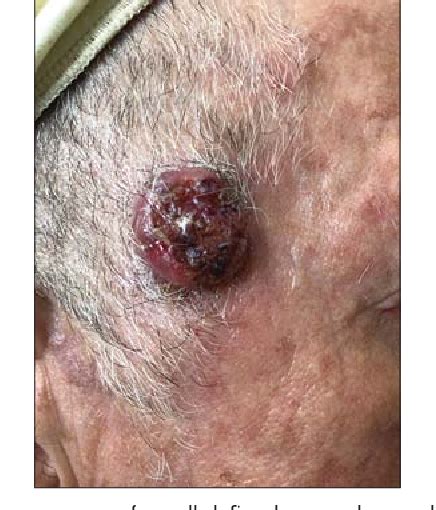 Figure 1 From Keratoacanthoma Or Squamous Cell Carcinoma Semantic Scholar