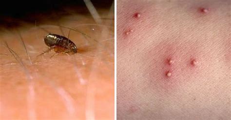 12 Common Bug Bites And How To Recognize Each One