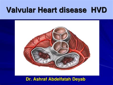 Ppt Valvular Heart Disease Hvd Powerpoint Presentation Free Download