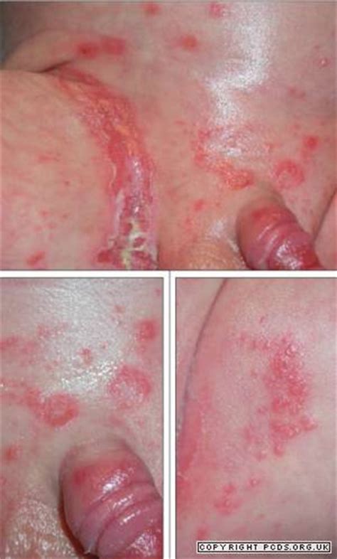 Intertrigo | Primary Care Dermatology Society | UK