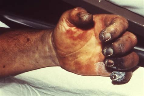 The plague, known as the black death, caused more fear and terror than perhaps any other infectious disease in history. 5 Horrifying Diseases Found On The NYC Subway