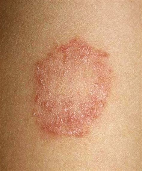 It's also called pityriasis versicolor. Tinea Corporis - Pictures, Treatment, Causes, Symptoms ...