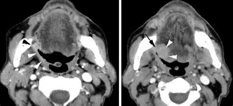Axial Contrast Enhanced Ct Images In A Patient With Right Sided