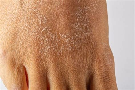 Winter Dry Skin Rash Causes Treatment And Prevention Medovie