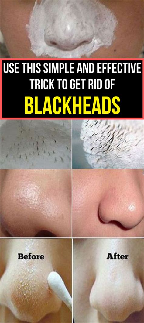 Simple And Effective Trick To Get Rid Of Blackheads Health And Tips