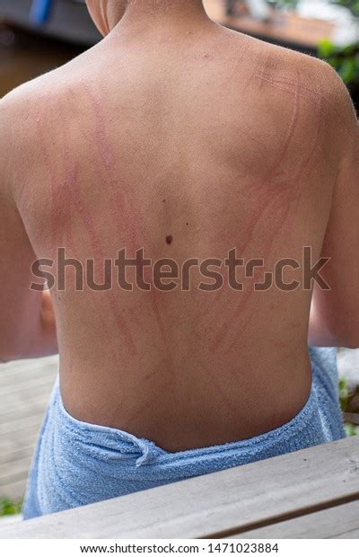 Dermatographic Urticaria Known Dermographism Dermatographism Skin Stock