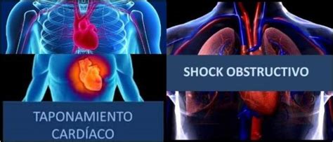 Shock Obstructivo Definición Causas Síntomas Diagnóstico Y