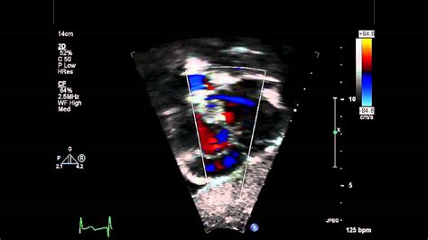 2:57 julián vega adauy 50 782 просмотра. Coronary Sinus ASD Subcostal View Color Doppler - YouTube