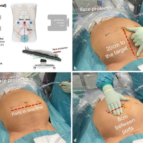 9 Positioning Of Ports For Robotic Inguinal Hernia Repair R Tapp A