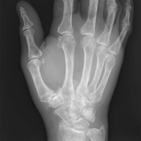 Pdf A Rare Case Of Acute Carpal Tunnel Syndrome Secondary To Calcific Tendinitis A Case Report
