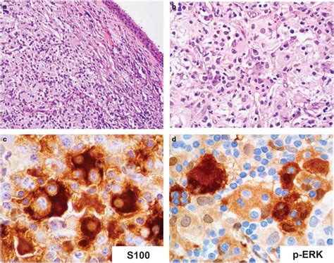 Map2k1 Mutated Rosai Dorfman Disease Nasopharynx Case 12 A