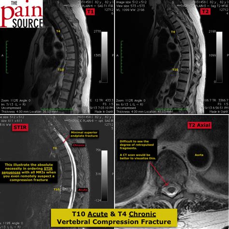 Vertebral Compression Fracture Mri Images The Pain Source Makes