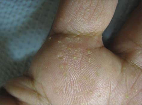 Unilateral Prickly Palmar Papules—quiz Case Dermatology Jama