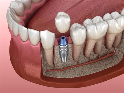 Single Tooth Implant Integrateddental Woodbury Ny
