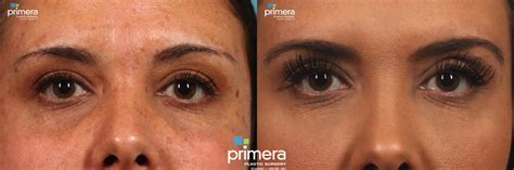 Chemical Peel Before And After Pictures Case 392 Orlando Florida Primera Plastic Surgery