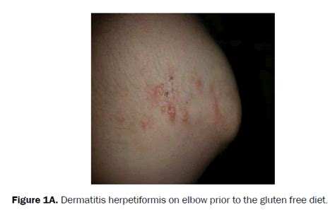 Successful Treatment Of Adult Onset Dermatitis Herpetiformis With Low