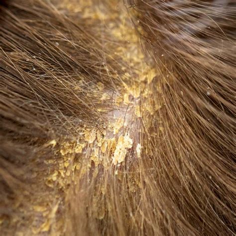 Dandruff In The Hair Flaky Scalp Seborrhea Stock Photo Image Of