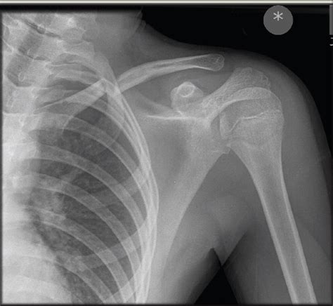 A Low Energy Paediatric Clavicle Fracture Associated With Acute