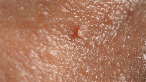 Wart Skin Removal Macro Shot Of Warts Near Eye On Face 7517545 Stock