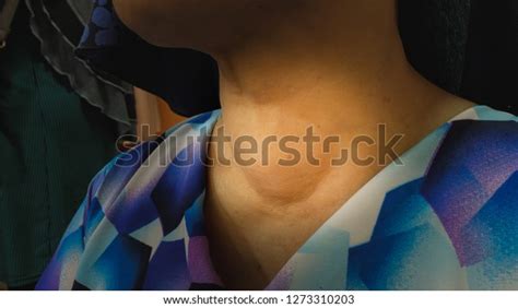 Anterior Next Swelling Thyroid Goitre Stock Photo 1273310203 Shutterstock