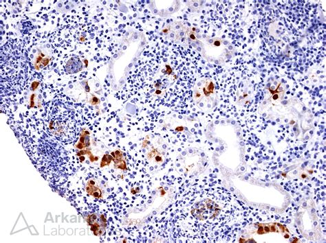 Adenovirus IHC Stain with Positive Staining in Tubular Epithelial Cells