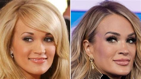 Carrie Underwood Plastic Surgery Before And After Photos