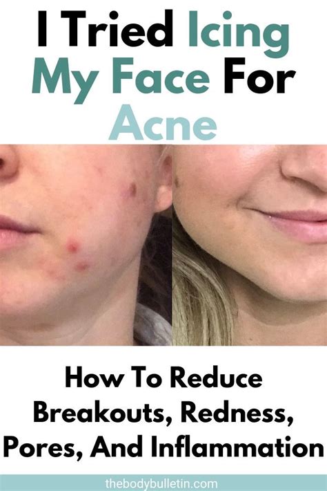 Icing a pimple reduces redness, swelling, and inflammation. The Ice Facial - Ice Your Face For Acne Prone Skin - #ACNE ...