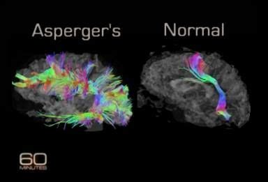 Affinities with syndromes of schizophrenia. droit à la neurodiversité - Recherche Google | Autiste
