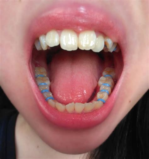 List 102 Pictures Pictures Of Stained Teeth After Braces Completed