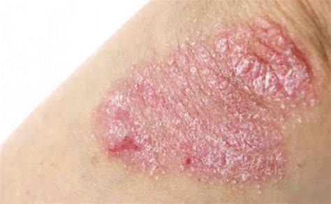 Nummular Eczema 10 Symptoms Of Nummular Eczema
