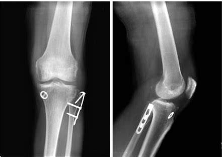 Surgical Management Of Comminuted Avulsion Fracture Of The Proximal Fibula With Lateral