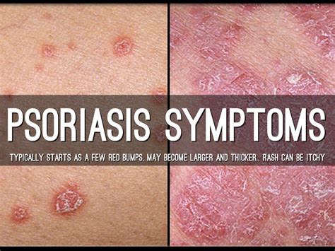 Psoriasis Facts And Symptoms Drug Addiction Facts