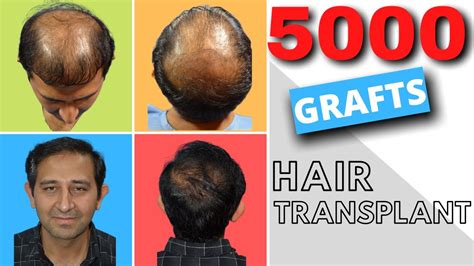 5000 Grafts Hair Transplant Cost India Turgid Journal Photo Galery